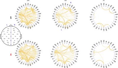 Dopaminergic Modulation of Local Non-oscillatory Activity and Global-Network Properties in Parkinson’s Disease: An EEG Study